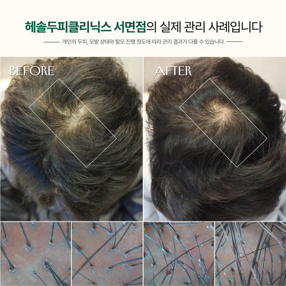 남성탈모 관리 사례 원본 이미지 5