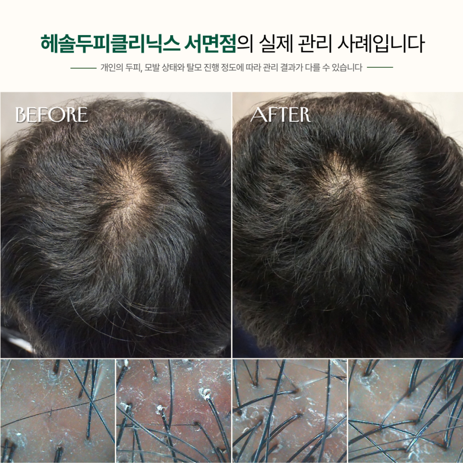 남성탈모 관리 사례 원본 이미지 1