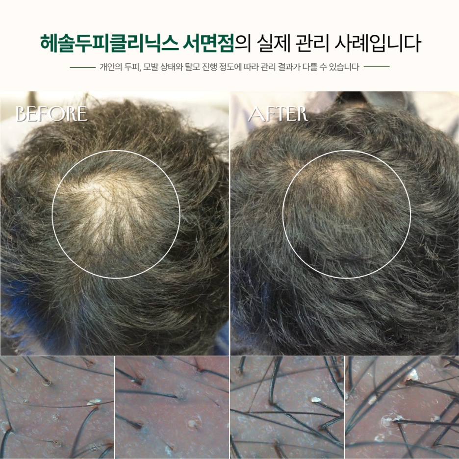 남성탈모 관리 사례 원본 이미지 2