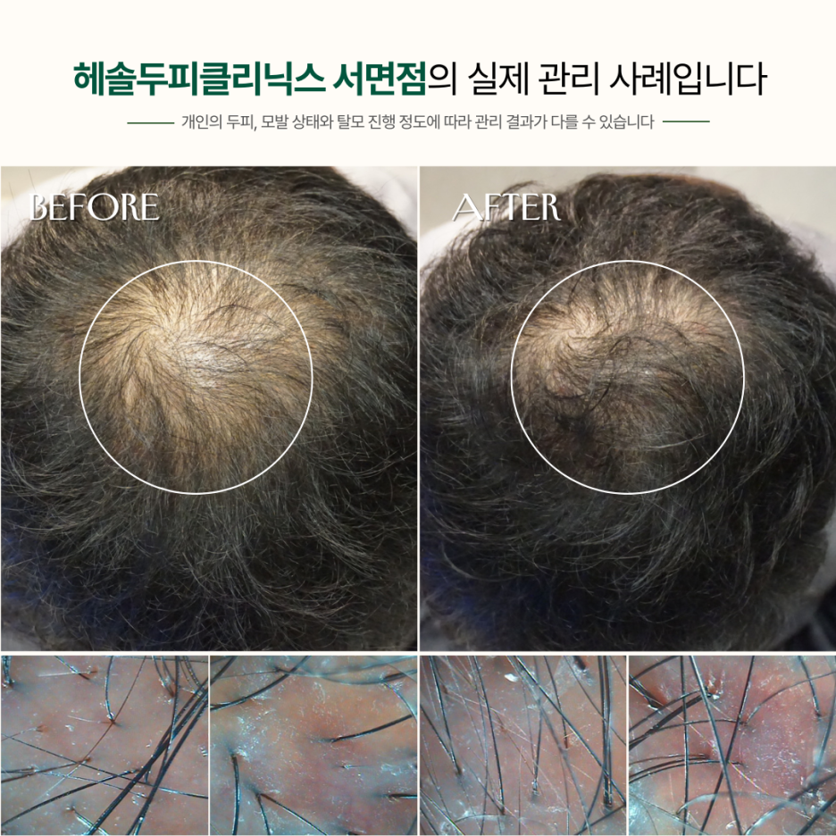 남성탈모 관리 사례 원본 이미지 4