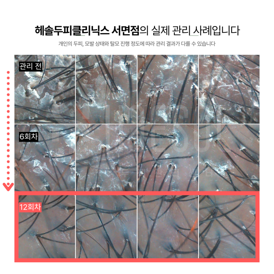 문제성두피 관리 사례 원본 이미지 2