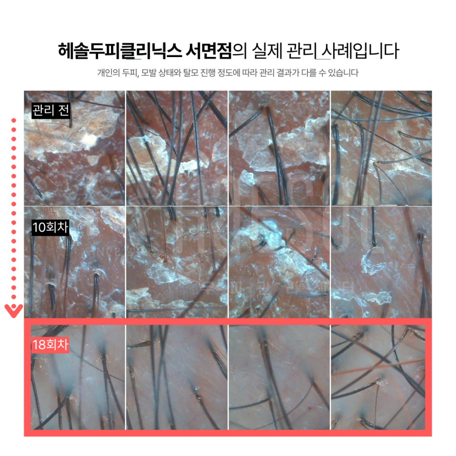 문제성두피 관리 사례 원본 이미지 3