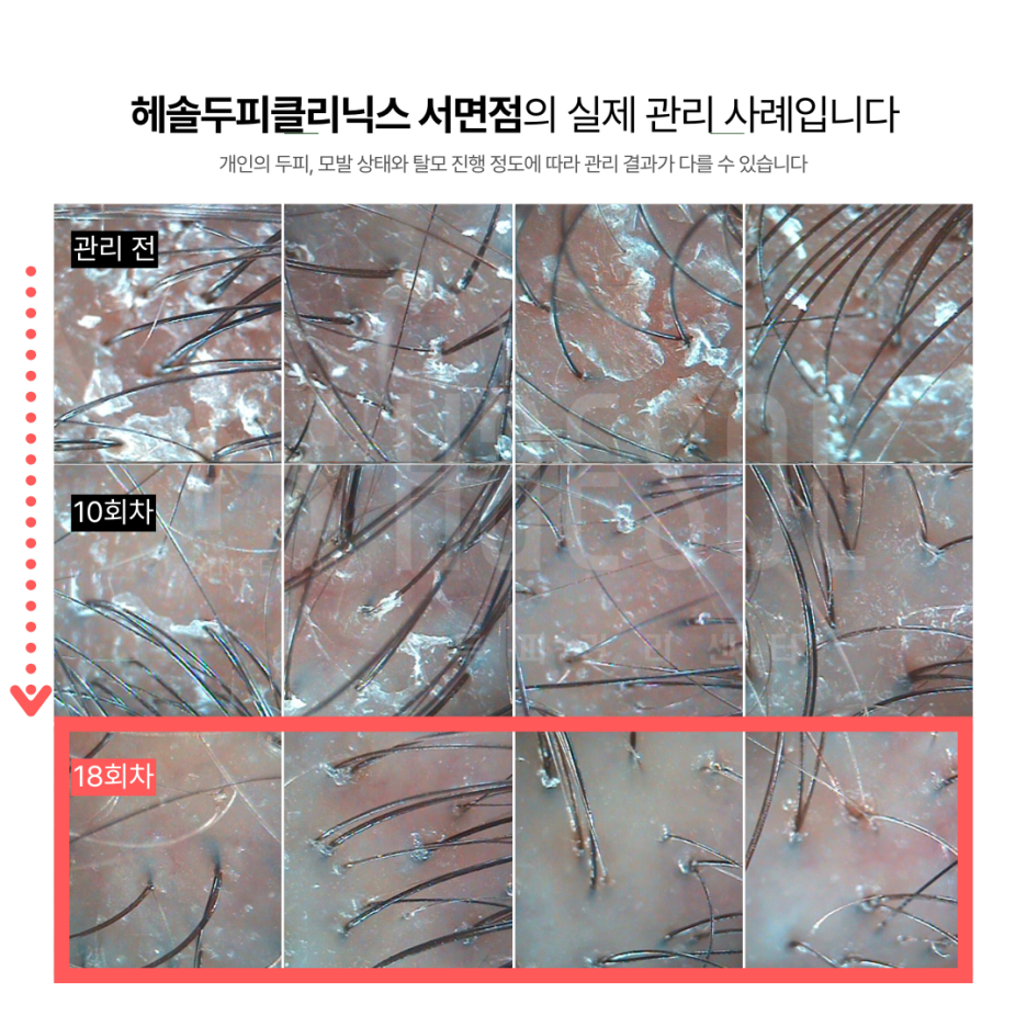 문제성두피 관리 사례 원본 이미지 4