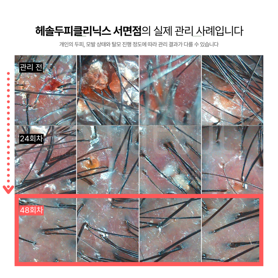 문제성두피 관리 사례 원본 이미지 5