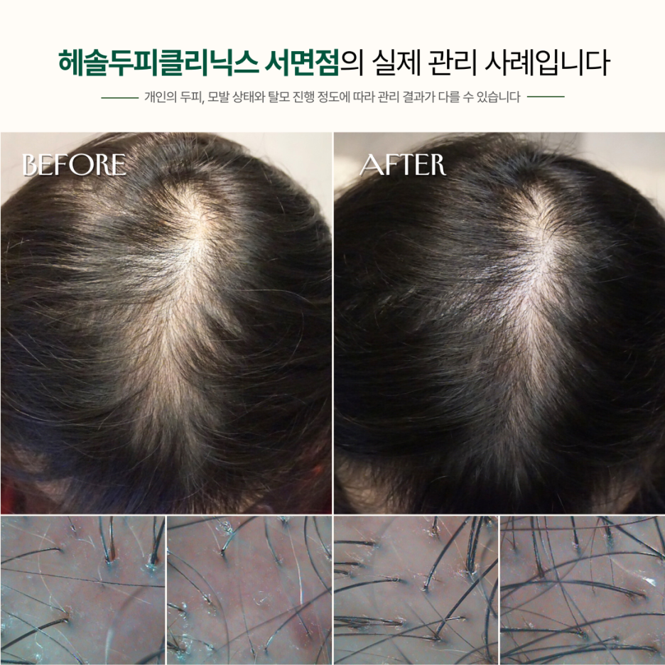 여성탈모 관리 사례 원본 이미지 2