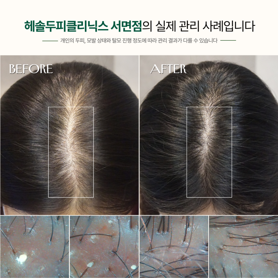 여성탈모 관리 사례 원본 이미지 3