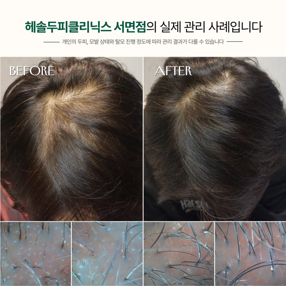 여성탈모 관리 사례 원본 이미지 4