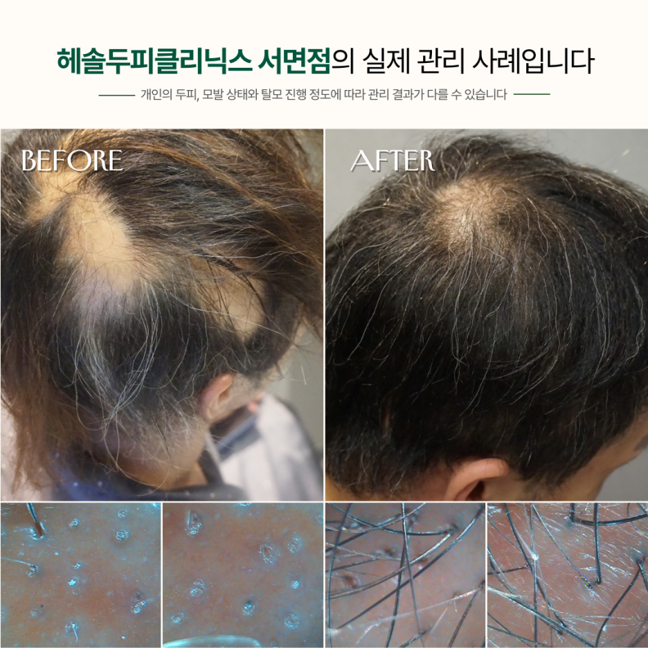 원형탈모 관리 사례 원본 이미지 1