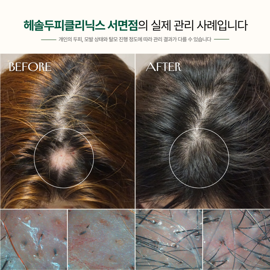원형탈모 관리 사례 원본 이미지 3